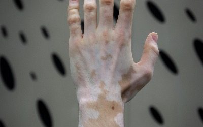Vitiligo – een holistische en spirituele kijk op pigmentverlies